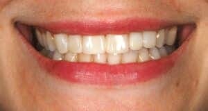 lauren composite bonding rochdale