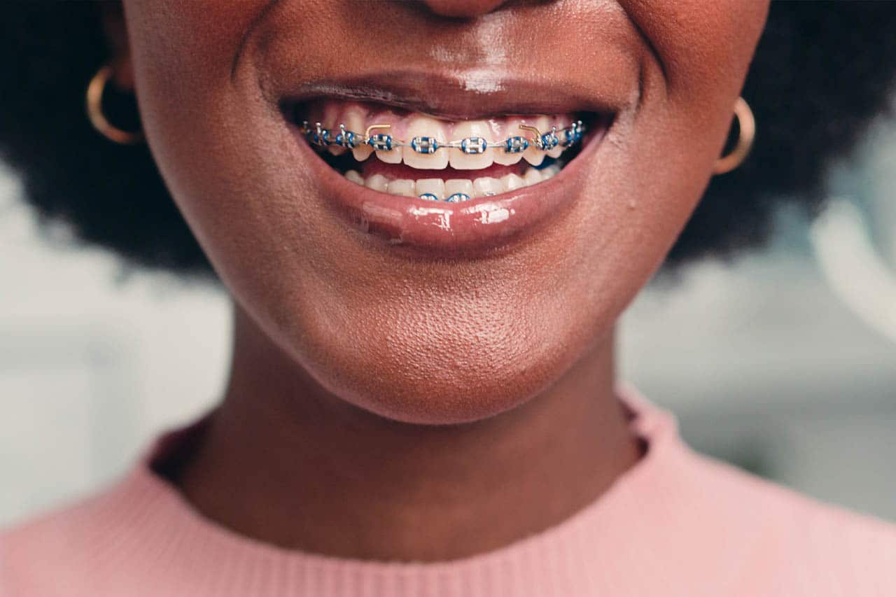 Benefits of Fixed Braces at Bamford Dental Practice
